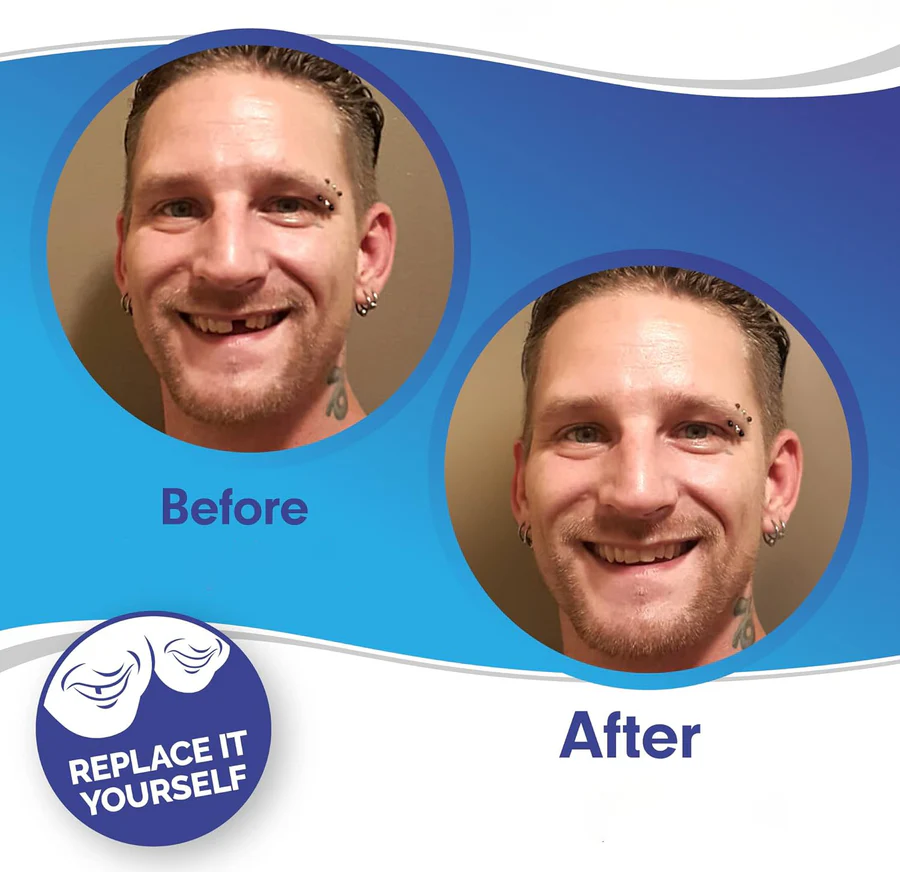 Complete Dental Veneer Kit - Upper & Lower Cosmetic Teeth Covers for a Perfect Smile