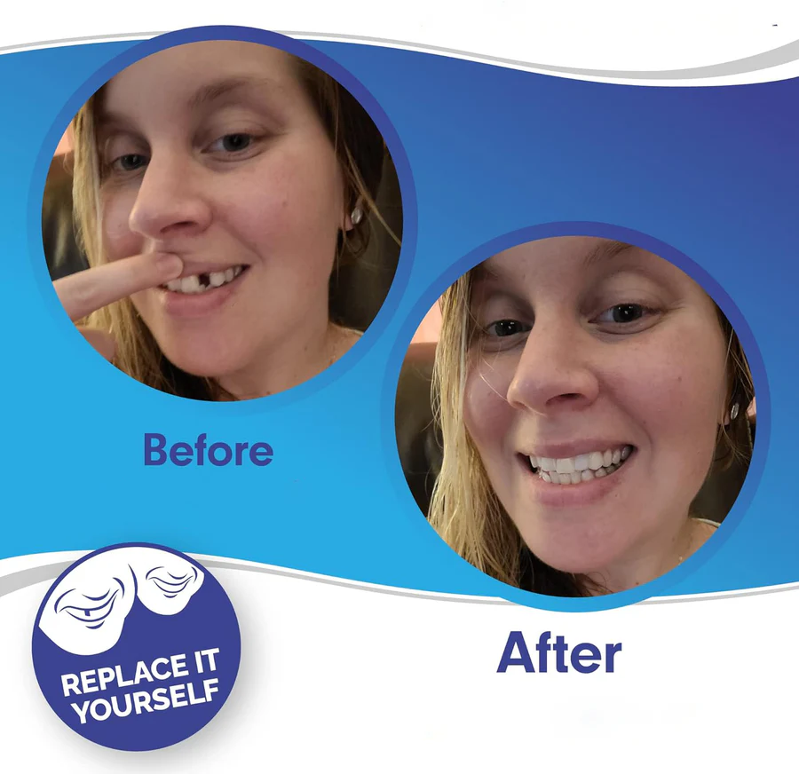 Complete Dental Veneer Kit - Upper & Lower Cosmetic Teeth Covers for a Perfect Smile