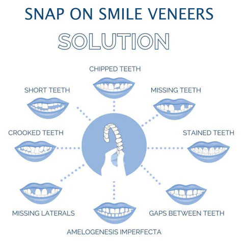 Complete Dental Veneer Kit - Upper & Lower Cosmetic Teeth Covers for a Perfect Smile