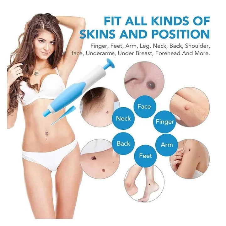 Skin Tag Removal Kit - Complete Set with Silicone Bands & Precision Pen Tool for Safe & Easy Removal