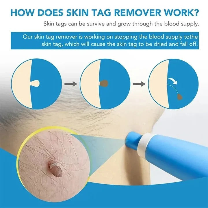 Skin Tag Removal Kit - Complete Set with Silicone Bands & Precision Pen Tool for Safe & Easy Removal