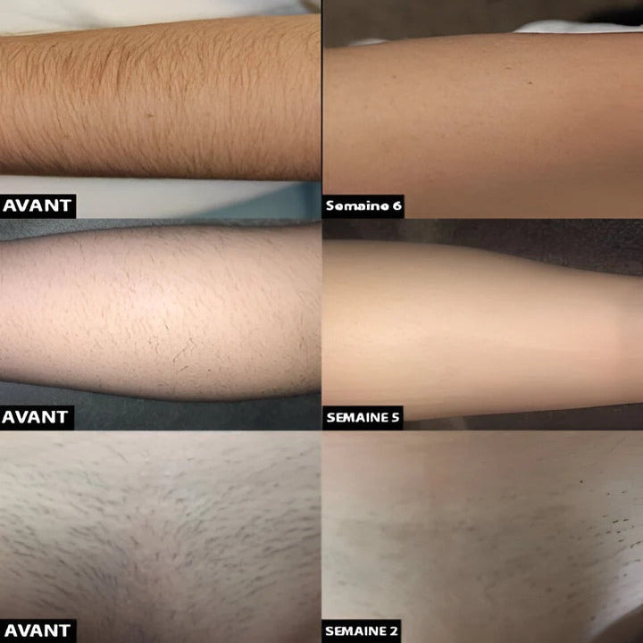 Rechargeable Light Pulse Hair Removal Device - Pain-Free, At-Home Laser Hair Removal System for Smooth Skin