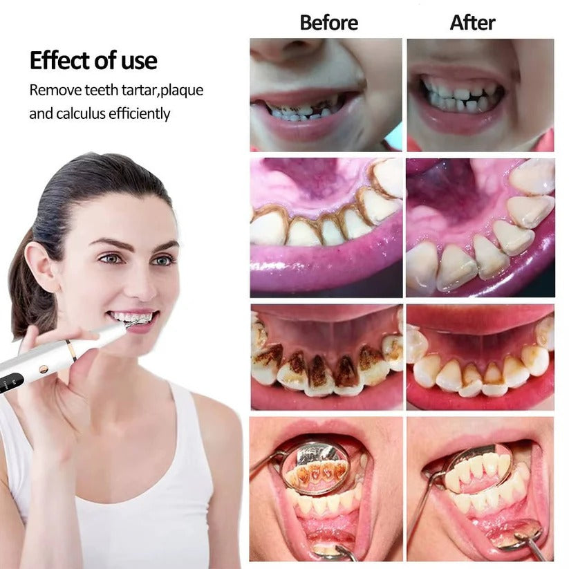 USB Rechargeable Dental Cleaning Kit with LED Light - Portable Oral Hygiene Tool for Teeth Whitening & Plaque Removal